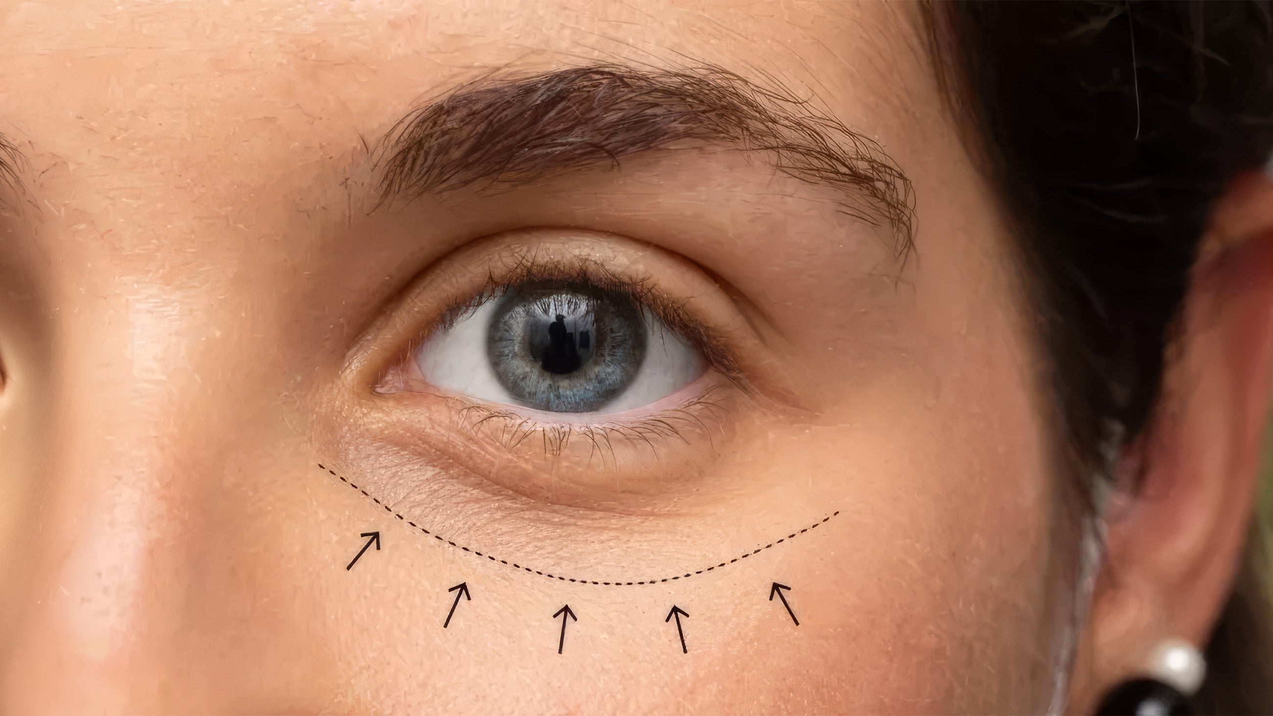 Under Eye Filler in Cincinnati: 7 Signs to Wait