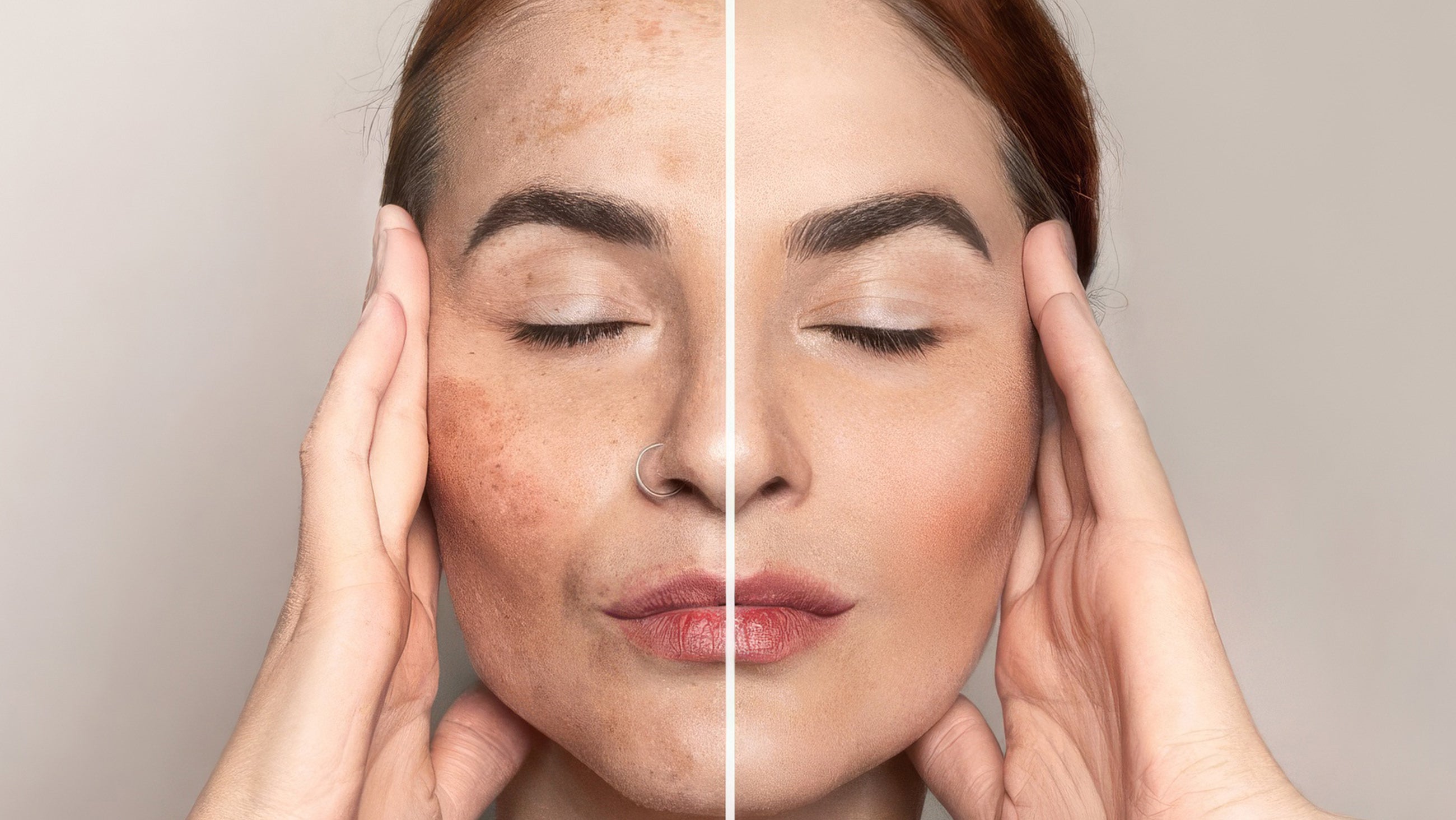 A natural hyperpigmentation treatment can help fade dark spots