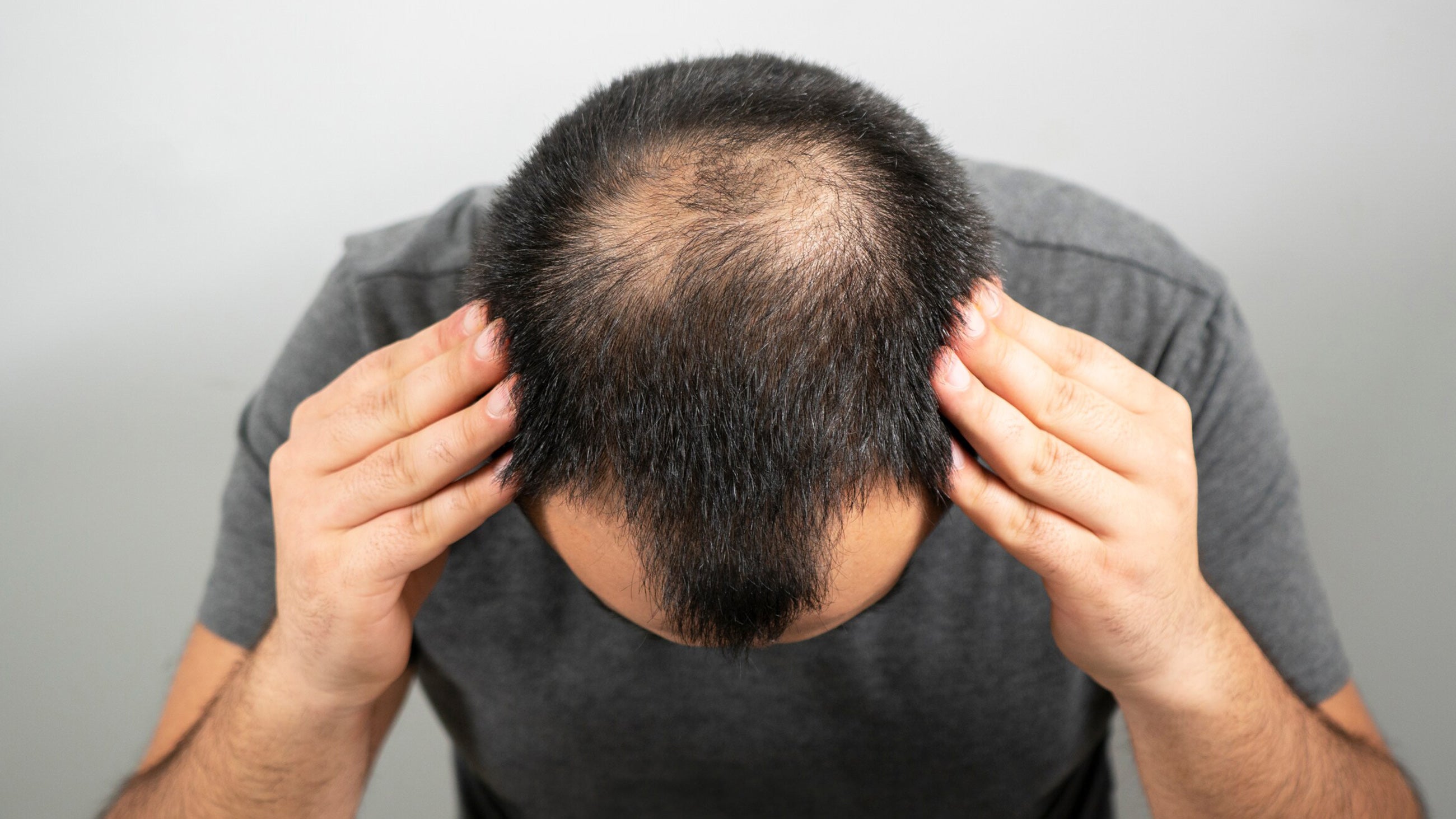 Thinning hair before PFP hair restoration Fix Studios Cincinnati Mason OH