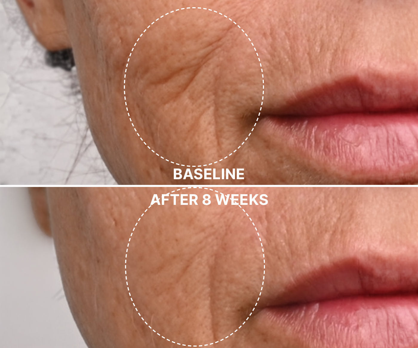 A before and after image of a woman's face after using Regenera™ Advanced Growth Factor Serum medical-grade anti-aging serum from Fix Studios shows visual improvement in her wrinkles and fine lines