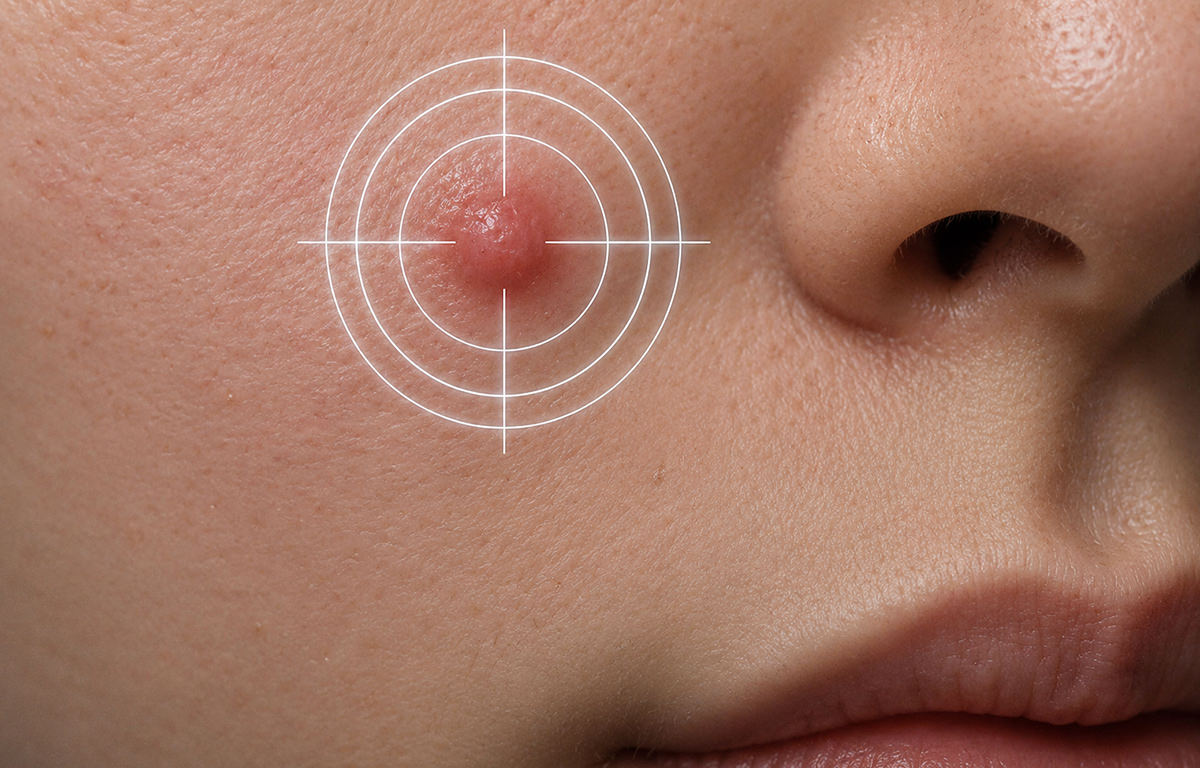 Fix Studios medical-grade SpotRx Precision Blemish Corrector Benzoyl Peroxide fast-acting acne spot treatment targets acne and clears skin in less than 3 days