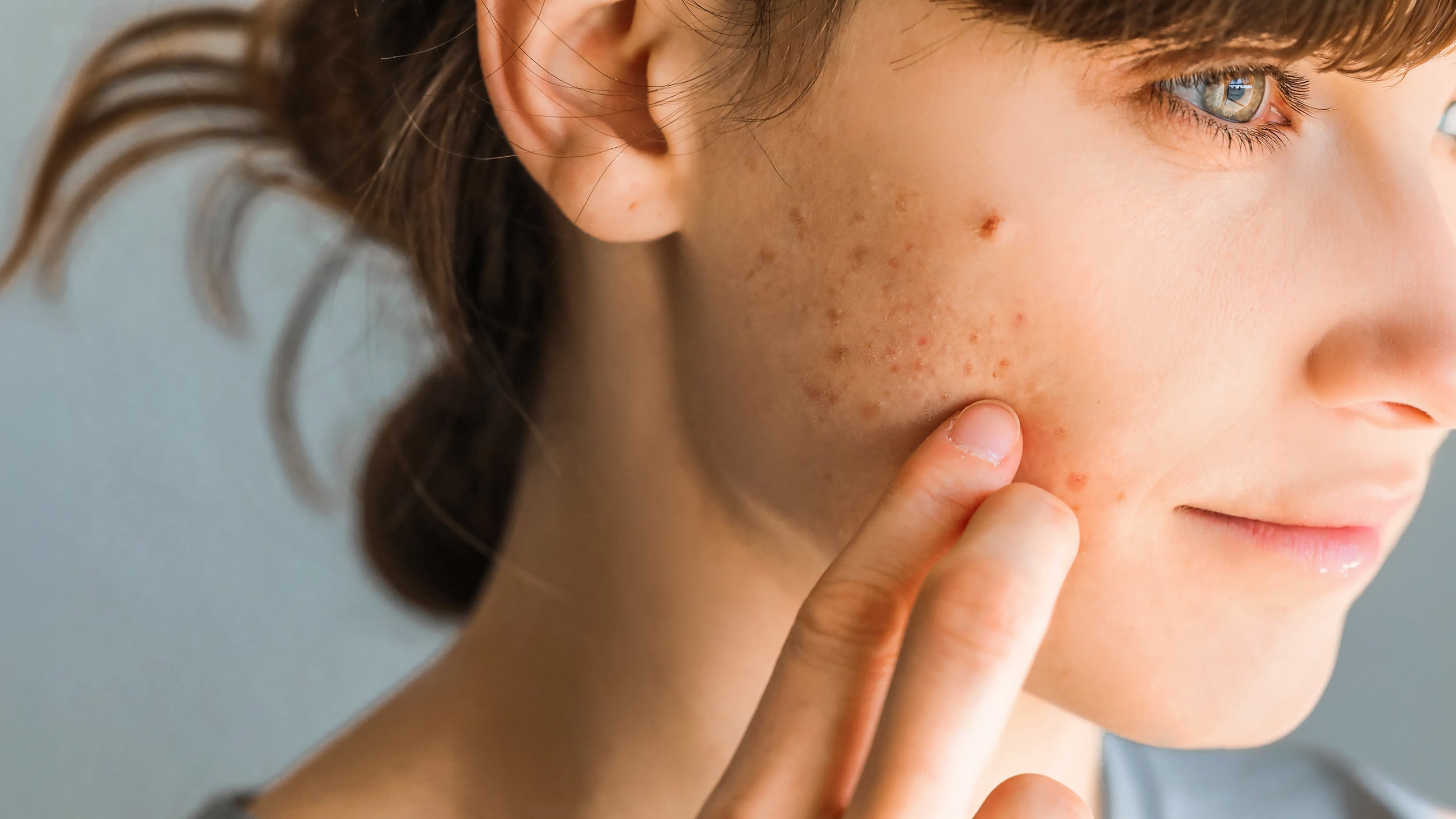 Purging vs Breakout: What Your Skin Is Really Saying (And What to Do Next)