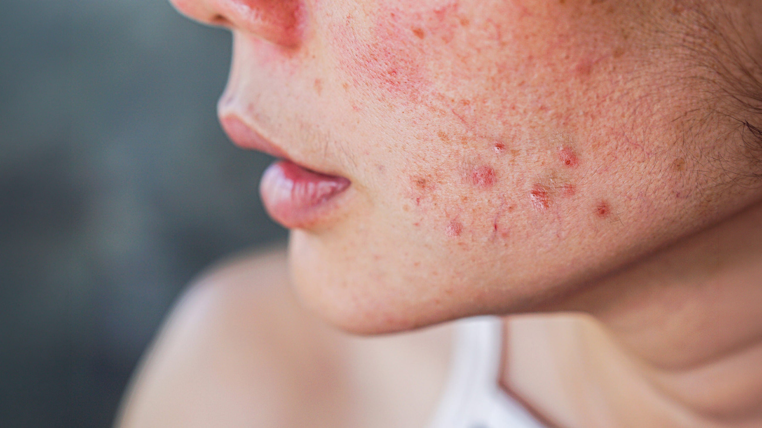 4 Skincare Habits Wrecking Your Skin Barrier