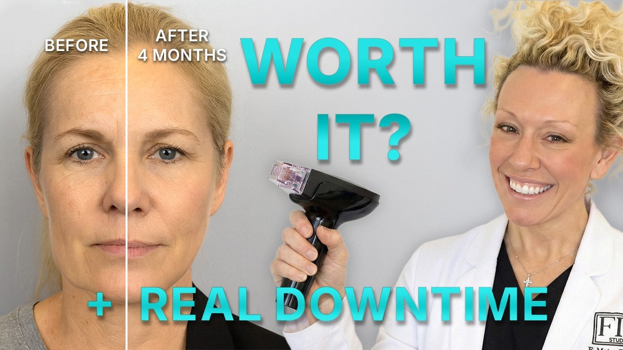 POV: You Just Got RF Microneedling (What Happens Next)