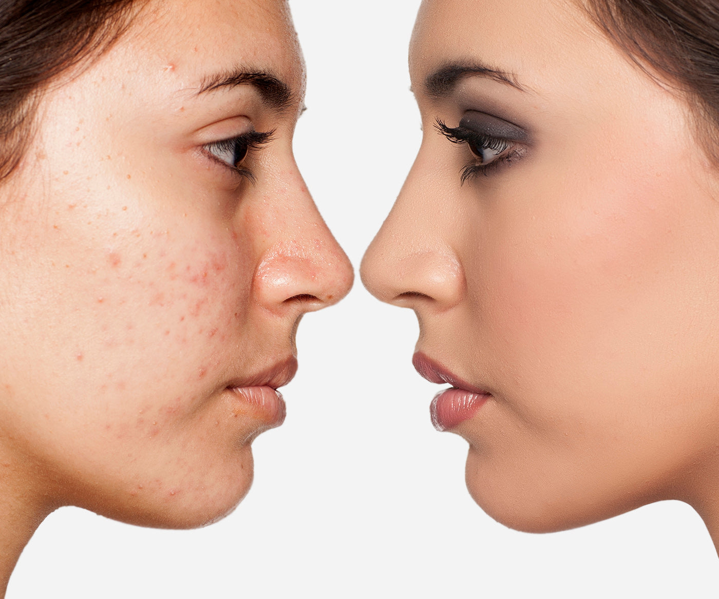 Acne Treatment services fix studios cincinnati mason OH
