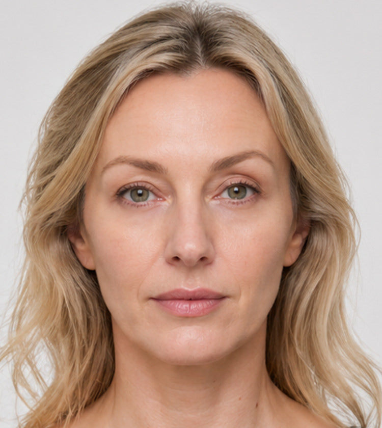 Botox and under-eye filler after photo showing subtle brow lift, smoother forehead lines, softened 11s and crow’s feet, and refreshed under-eyes after treatment at Fix Studios Cincinnati Mason OH.