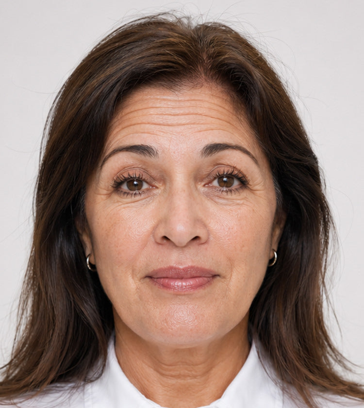 Botox before photo showing repeated horizontal forehead lines before treatment at Fix Studios Cincinnati Mason OH.