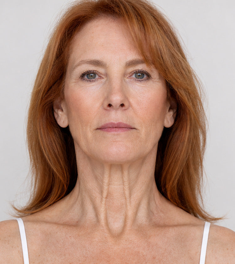 Botox before photo showing visible platysmal neck bands before treatment at Fix Studios Cincinnati Mason OH.