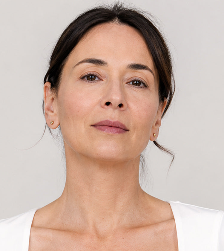 Botox after photo showing softened platysmal bands, smoother forehead lines, reduced 11s, and refreshed crow’s feet after treatment at Fix Studios Cincinnati Mason OH.