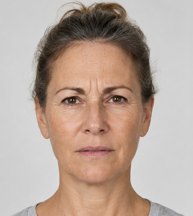 Botox before photo showing forehead lines, 11s, crow’s feet, and natural upper lip appearance before treatment at Fix Studios Cincinnati Mason OH.