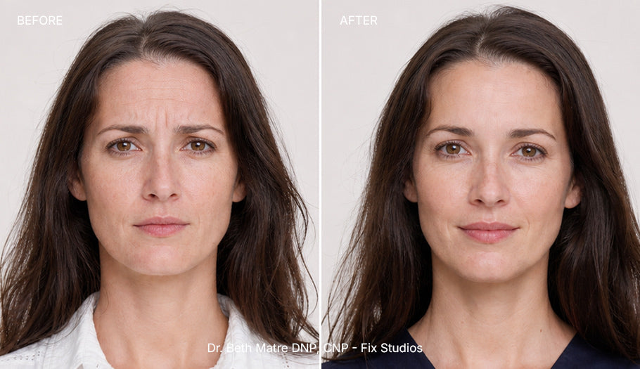 Botox treatments and services fix studios medspa cincinnati mason OH. Botox before and after